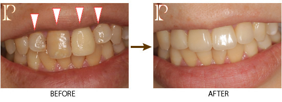 ホワイトニング01