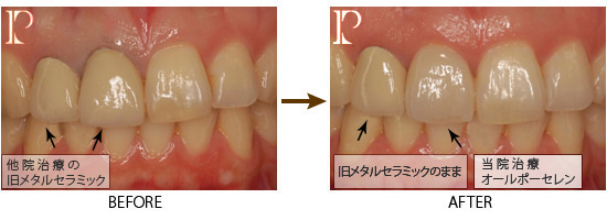 ホワイトニング01