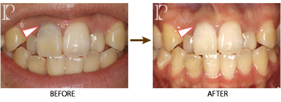 ホワイトニング（1本の歯のみの場合)
