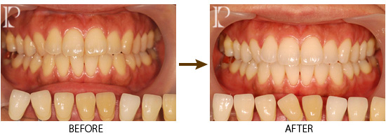 ホワイトニング01