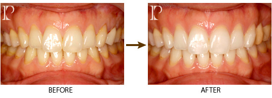 ホワイトニング02