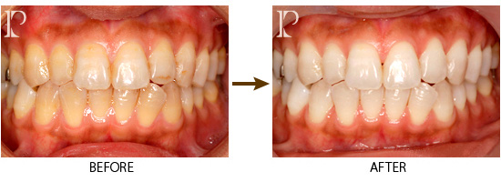 ホワイトニング03