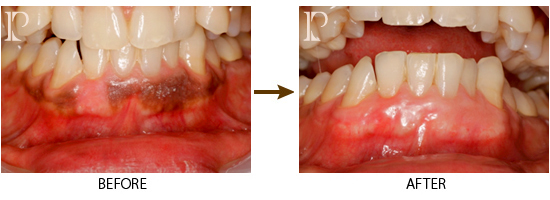 歯肉ブライトニング