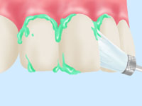 1.歯石、着色などの除去、クリーニング