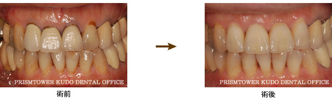 審美歯科症例Case 2