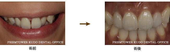 審美歯科症例Case 3