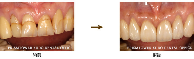 審美歯科症例Case 4