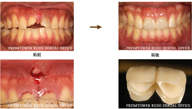 審美歯科症例Case 6