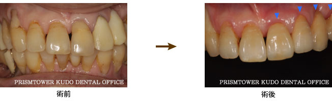 審美歯科症例Case 7