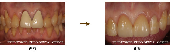 審美歯科症例Case 9