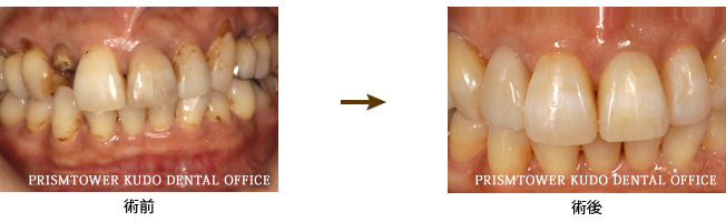 審美歯科症例Case 10