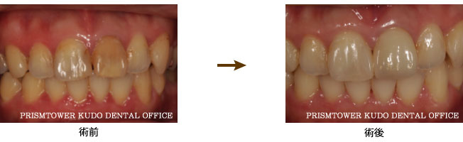 審美歯科症例Case 11