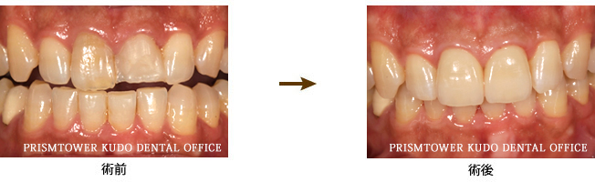 審美歯科症例Case 12