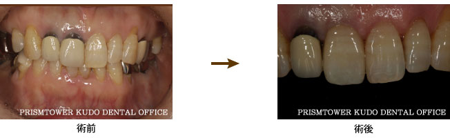 審美歯科症例Case 13