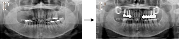 インプラント症例Case 4