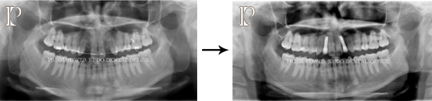 インプラント症例Case 5