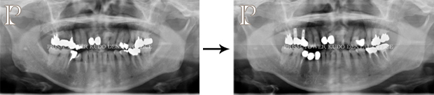 インプラント症例Case 6