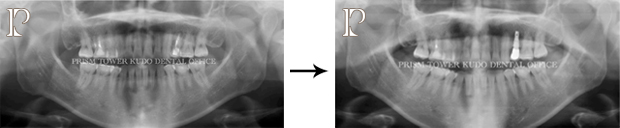 インプラント症例Case 7