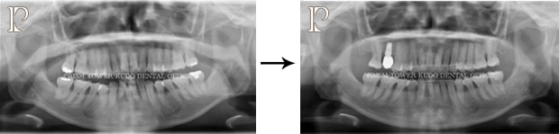 インプラント症例Case 10