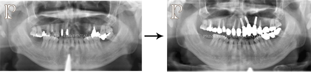 インプラント症例Case 11