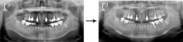 インプラント症例Case 12