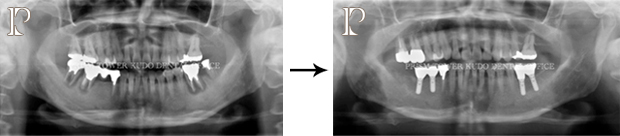 インプラント症例Case 14