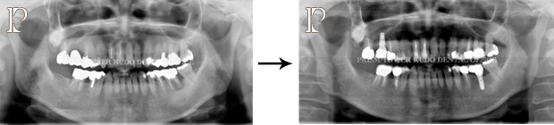 インプラント症例Case 16