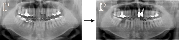 インプラント症例Case 18